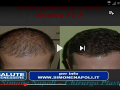 Autotrapianto di capelli